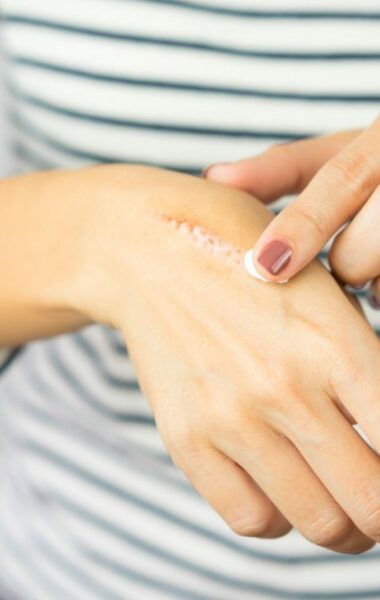 Hoe moet je een litteken verzorgen? Blog BAPSCARCARE